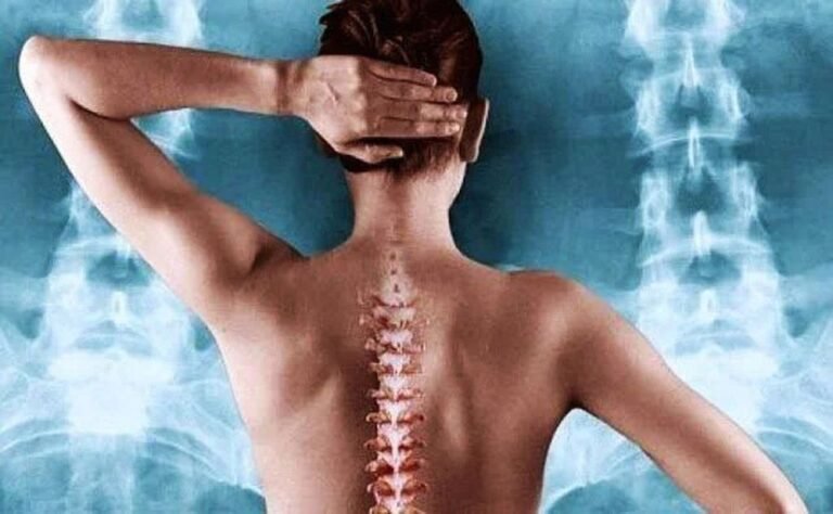 Οστεοπόρωση: πρόληψη πριν τα κατάγματα